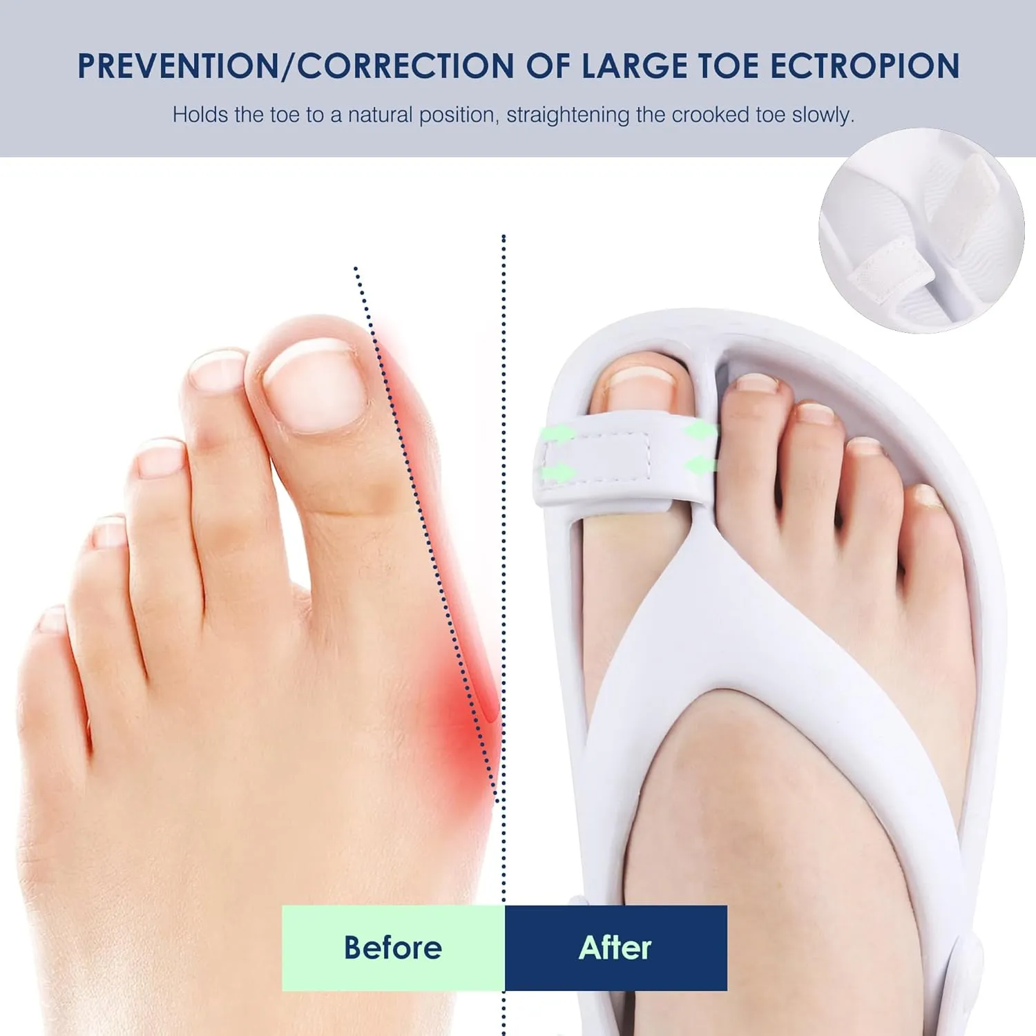 Ortho rest Women Orthopedic Bunion Sandals Orthotic Slides Walking Sandals